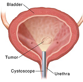 Bladder Biopsy