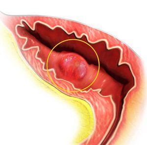 Bladder Cancer