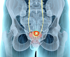  Bladder Pain 