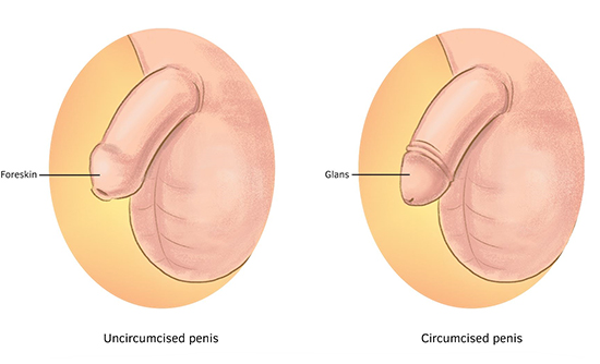 Circumcision