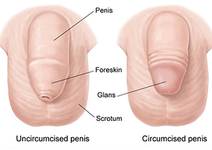 Circumcision Revision