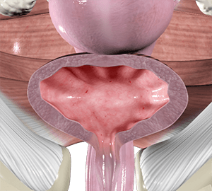 Cystitis