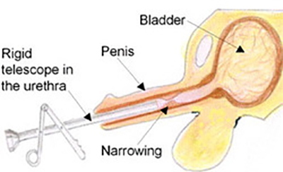 Direct Vision Internal Urethrotomy