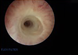 Direct Vision Internal Urethrotomy