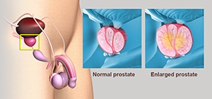 Enlarged Prostate 