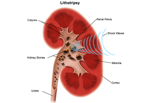 Extracorporeal Shock Wave Lithotripsy