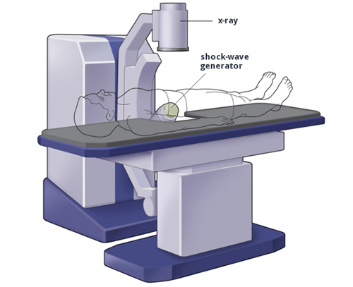 Extracorporeal Shockwave Lithotripsy