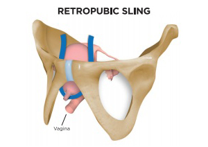 Female Mid-Urethral Sling
