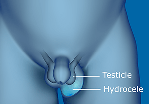 Hydrocele