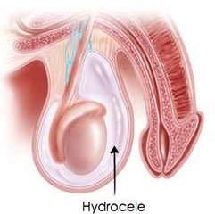 Hydrocelectomy