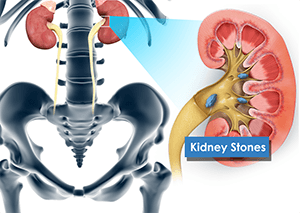 Kidney Surgery