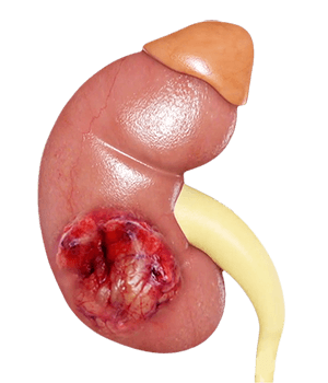 Kidney Tumors 