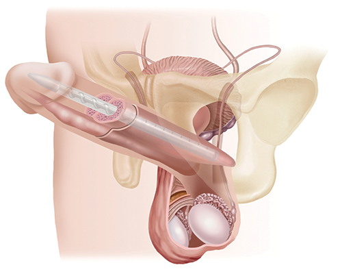 Malleable Penile Prosthesis