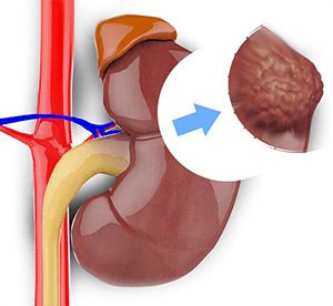 Nephrectomy