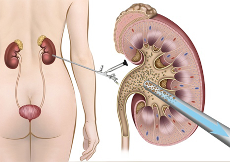 Percutaneous Nephrolithtomy