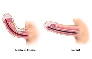  Peyronie's Disease  