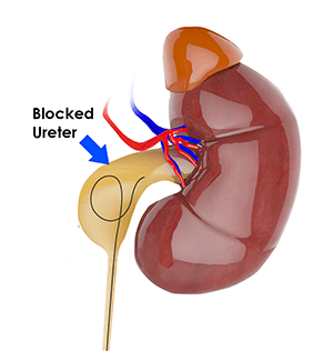  Pyeloplasty 