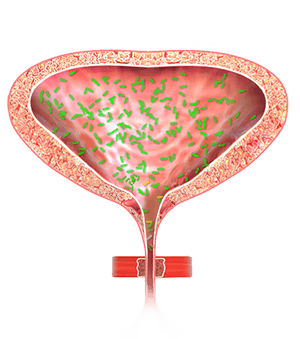  Recurrent Bladder Infections 