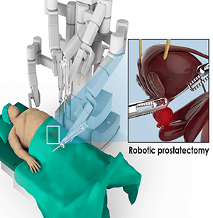 robotic prostatectomy