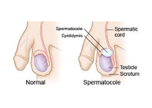 Spermatocelectomy
