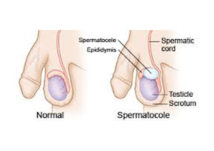 Spermatocele