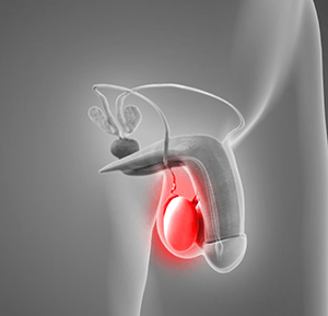   Testicular Pain 