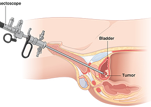  Transurethral Resection of Bladder Tumor (TURBT) 