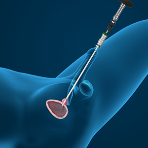 prostate cancer types prostatitis ureablasmus férfiakban