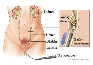 ureteroscopic-lithotripsy