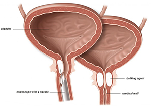 Urethral Bulking image