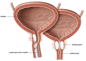 Urethral Bulking