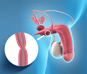 Urethral Stricture 