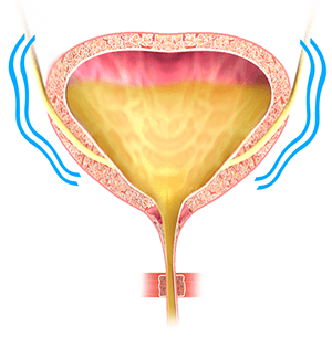 Urinary Incontinence in Women