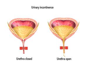 Urinary Incontinence 