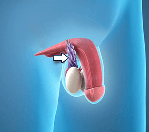   Varicocele  