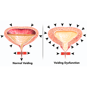 Voiding Dysfunction